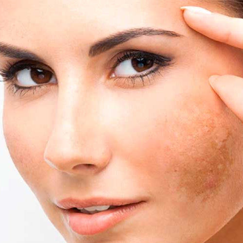 Premium Luz Serena – Melasma