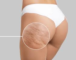 ✨ Ritual Anticelulitis MDÁBAL ✨